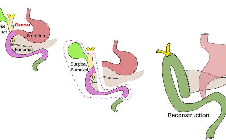  Robotic Pylorus – Preserving Whipple Procedure